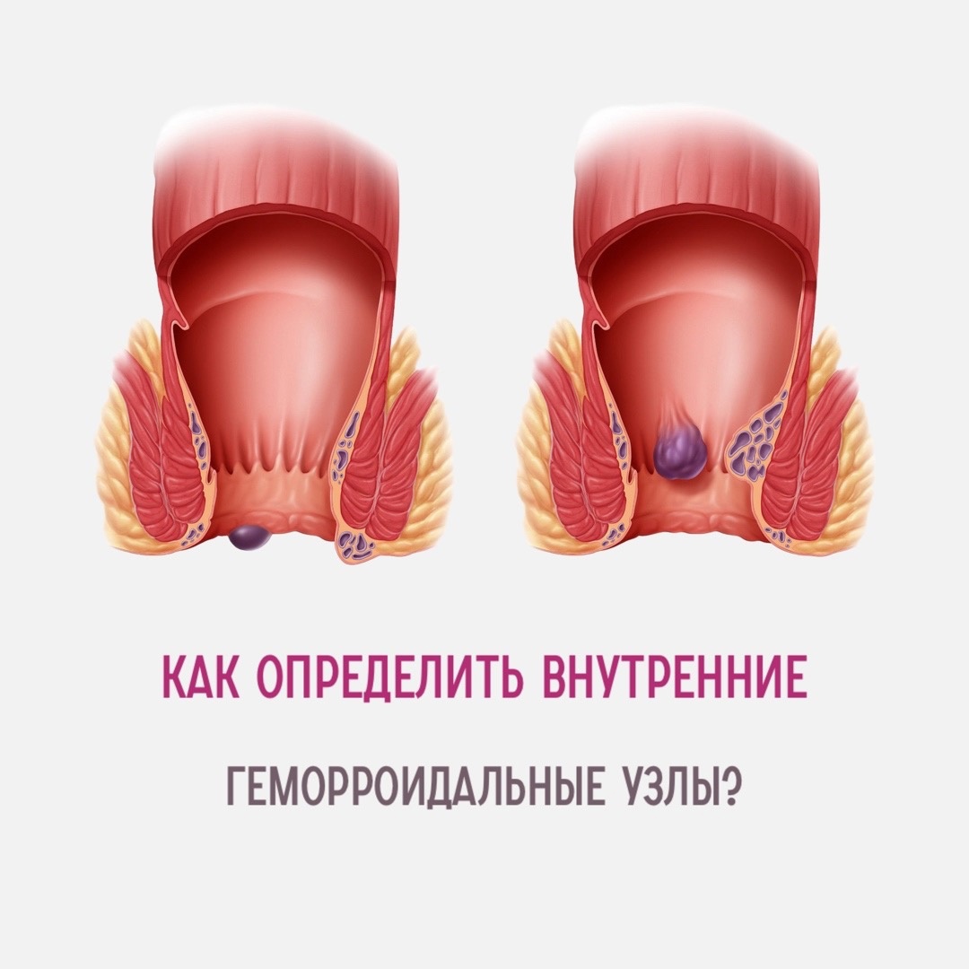 Кровит После Анального Секса Кровит После Анального Секса