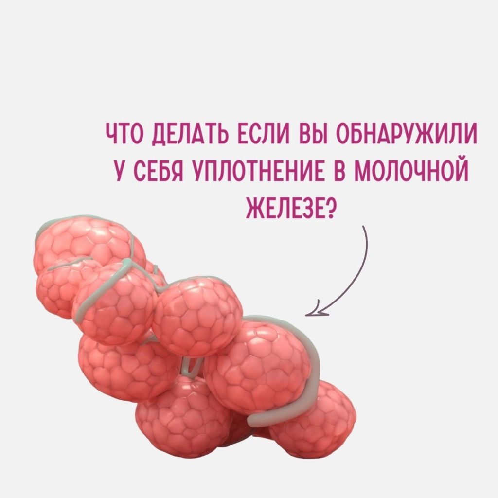 Что делать если Вы обнаружили у себя уплотнение в молочной железе?