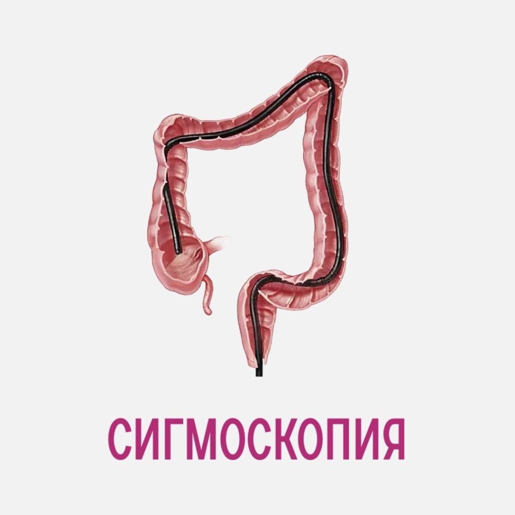 Сигмоскопия