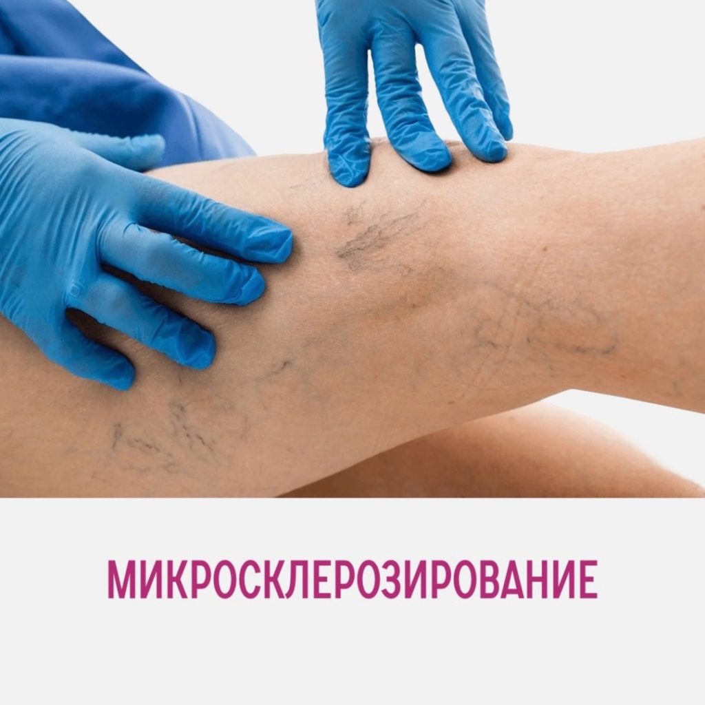 Микросклеротерапия