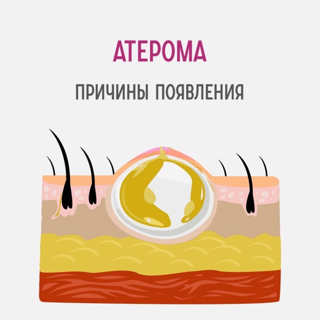 Атерома: причины появления