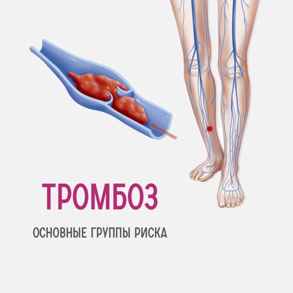 Тромбоз-группы риска
